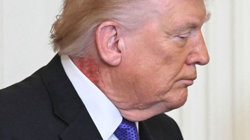 Trump’s Neck Rash? Just His Skin’s Way of ‘Preventing’ Criticism!