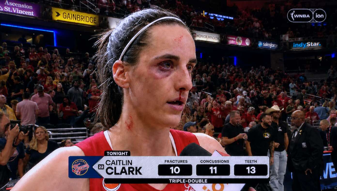 Caitlin Clark Records Triple Double With 10 Fractures, 11 Concussions, 13 Teeth Knocked Out